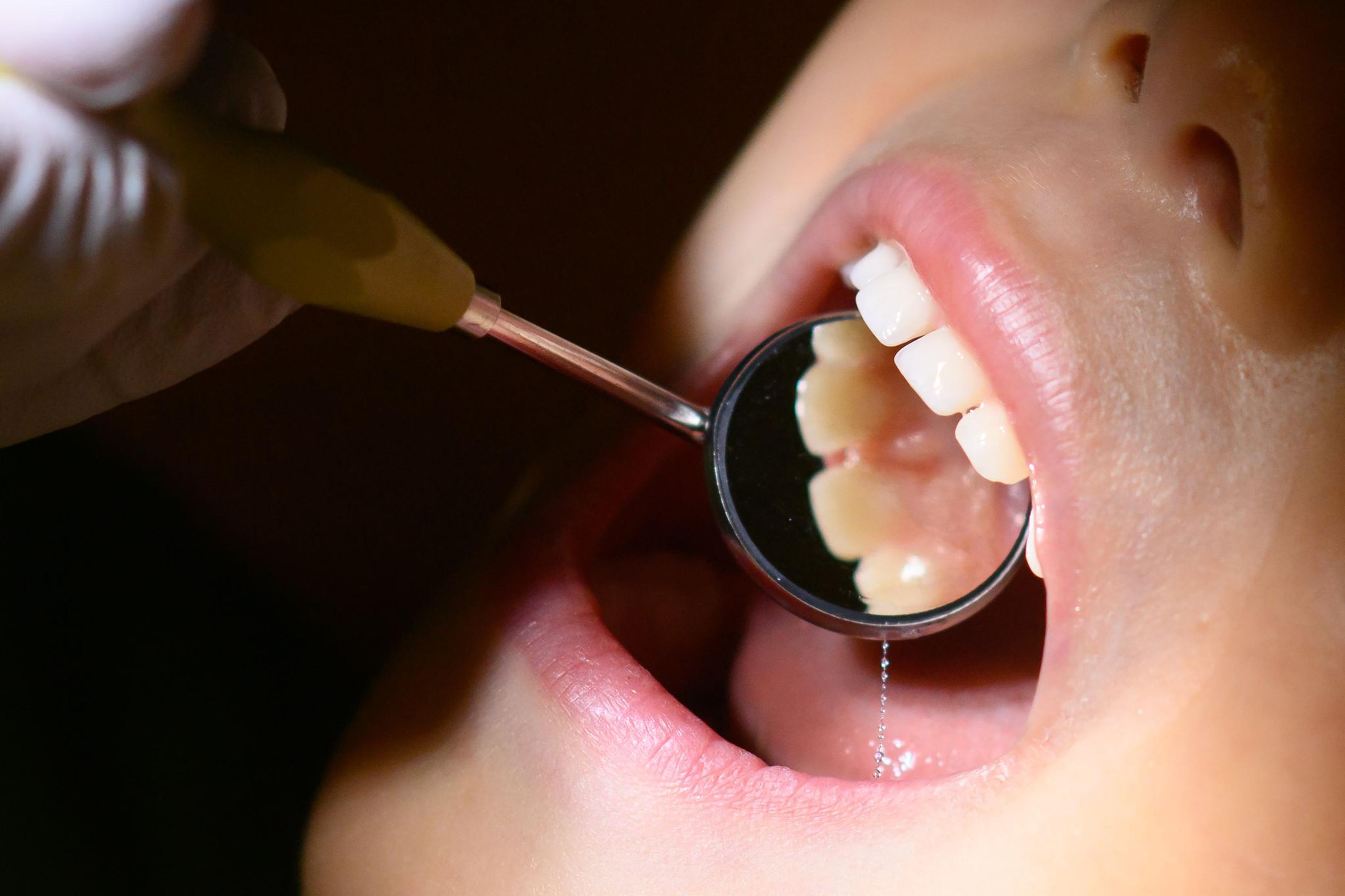 Fluoridlack soll die Zähne vor Karies schützen. Seit dem 24. April 2024 haben nun alle Kinder unter sechs Jahren unabhängig vom Kariesrisiko einen Anspruch auf diese Leistung.