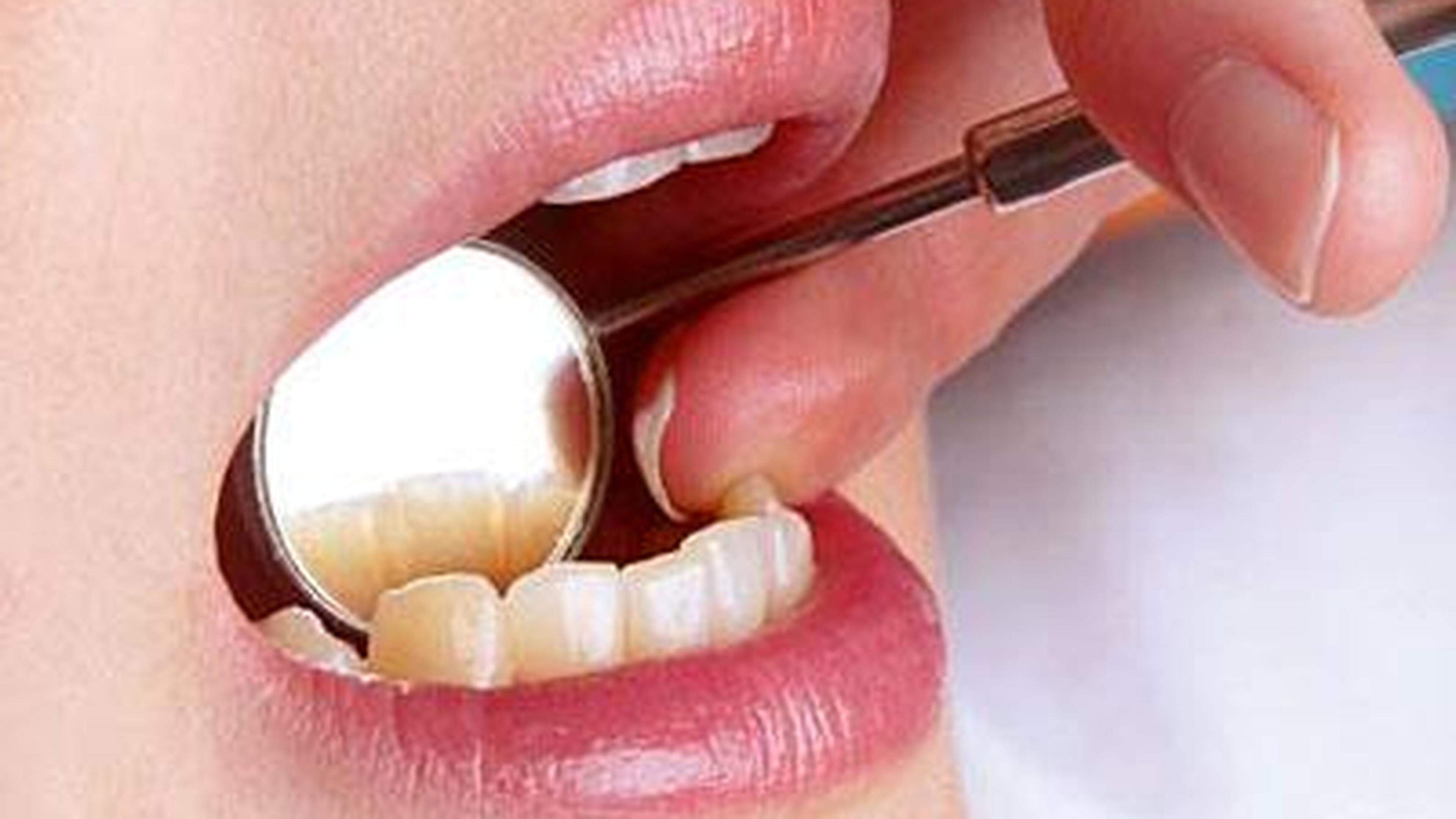 Bei der professionellen Zahnreinigung werden harte und weiche Beläge aus den Zahnzwischenräumen entfernt.